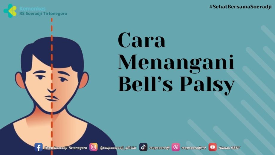 Cara Menangani Bell’s Palsy